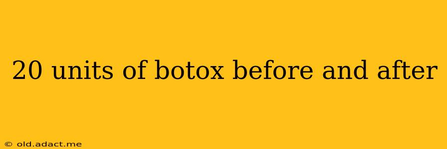 20 units of botox before and after