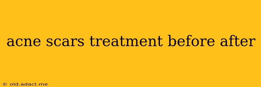 acne scars treatment before after
