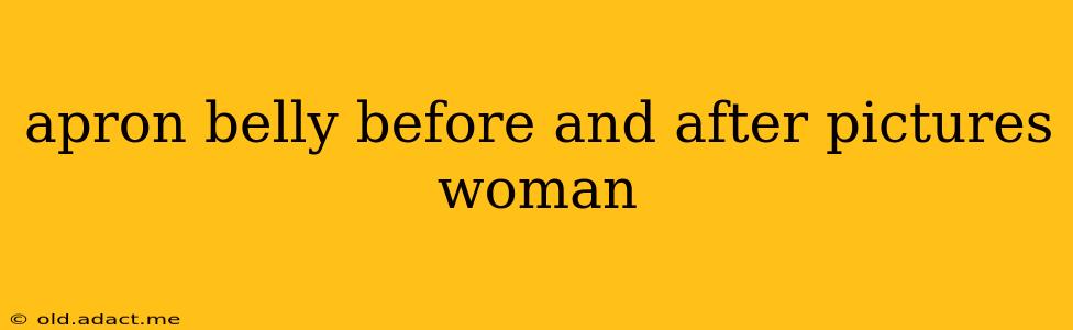 apron belly before and after pictures woman