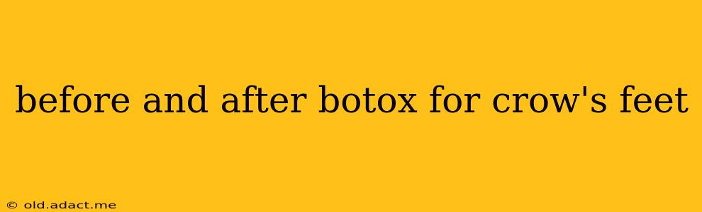 before and after botox for crow's feet