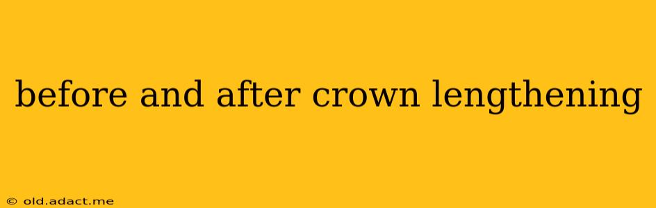 before and after crown lengthening