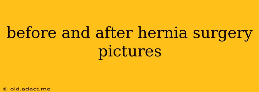 before and after hernia surgery pictures