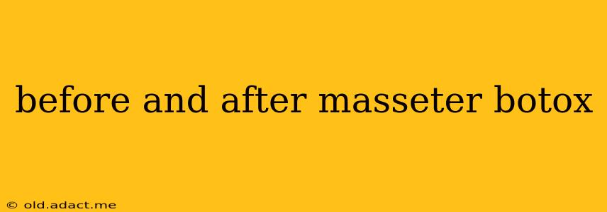 before and after masseter botox