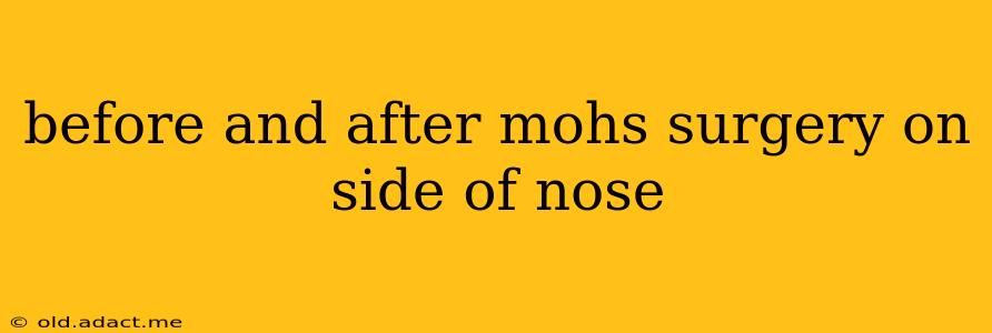 before and after mohs surgery on side of nose