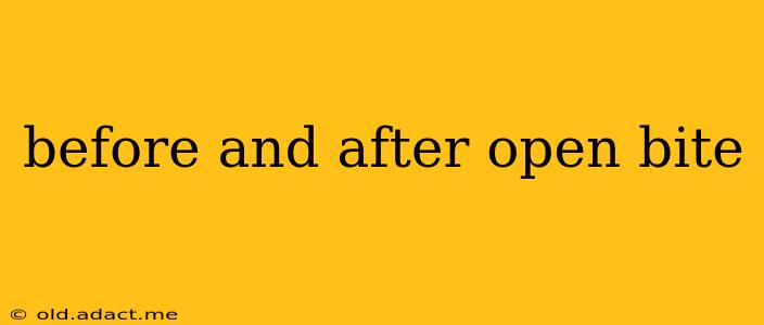 before and after open bite