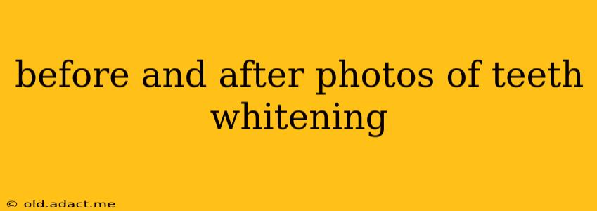 before and after photos of teeth whitening