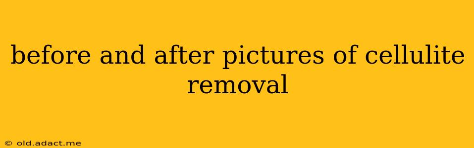 before and after pictures of cellulite removal