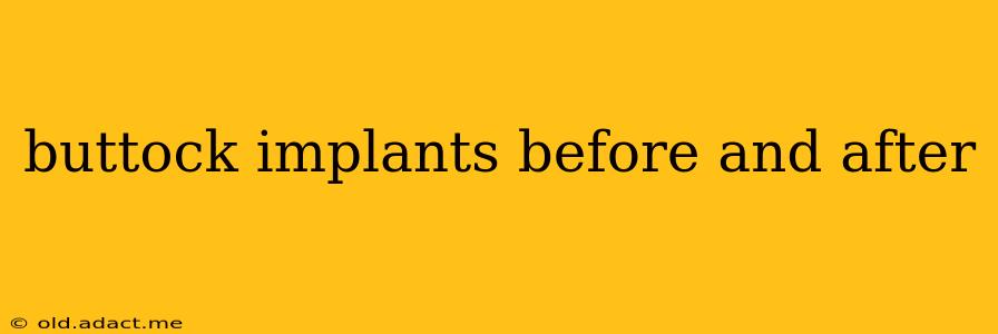 buttock implants before and after