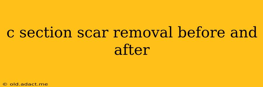 c section scar removal before and after
