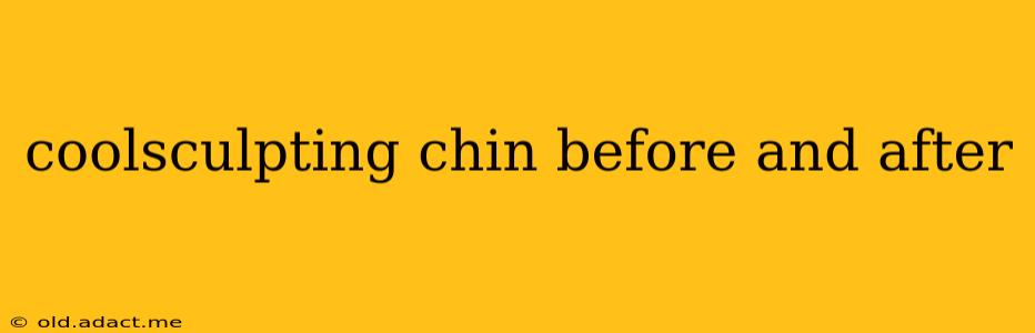 coolsculpting chin before and after