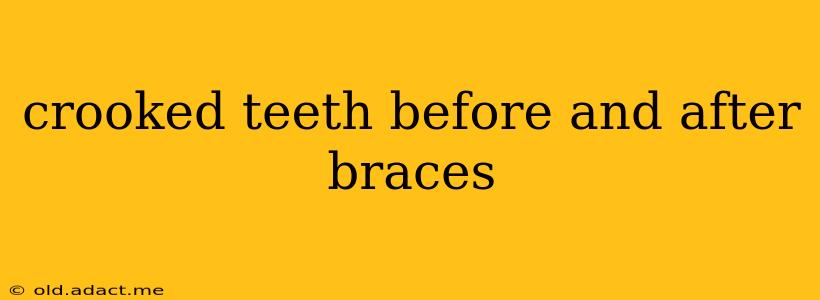 crooked teeth before and after braces