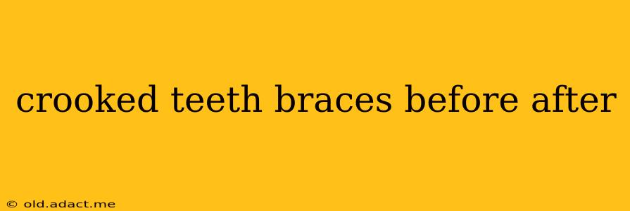 crooked teeth braces before after