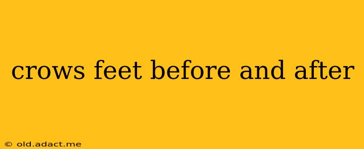 crows feet before and after