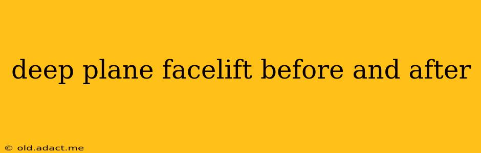 deep plane facelift before and after