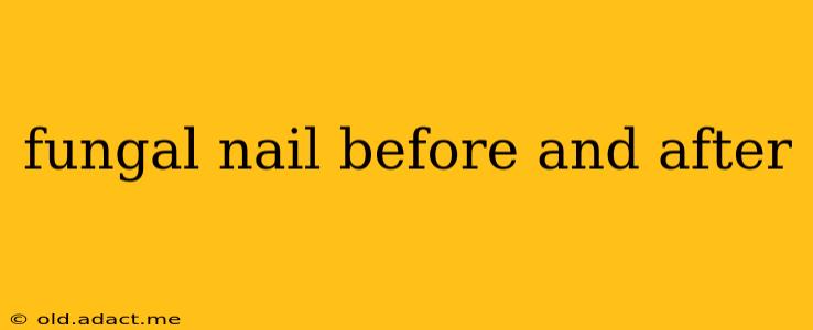 fungal nail before and after