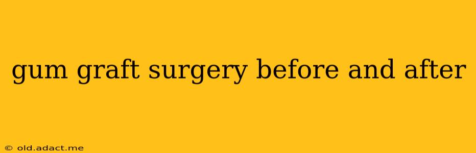 gum graft surgery before and after