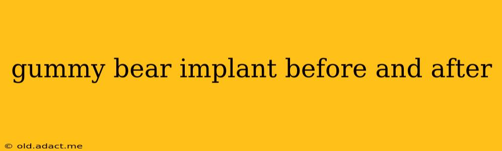 gummy bear implant before and after