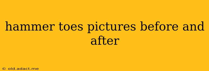 hammer toes pictures before and after