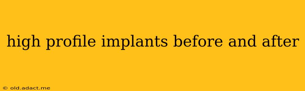 high profile implants before and after