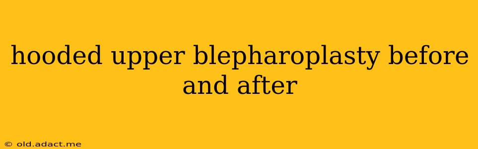 hooded upper blepharoplasty before and after