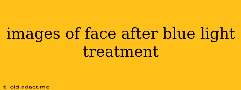 images of face after blue light treatment