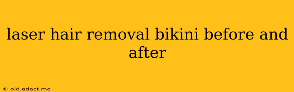 laser hair removal bikini before and after
