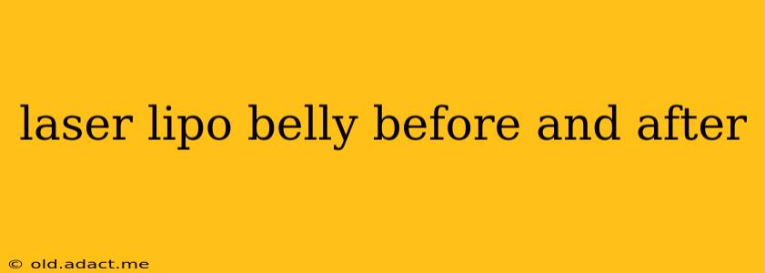 laser lipo belly before and after