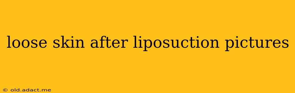 loose skin after liposuction pictures