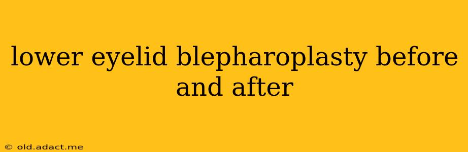 lower eyelid blepharoplasty before and after