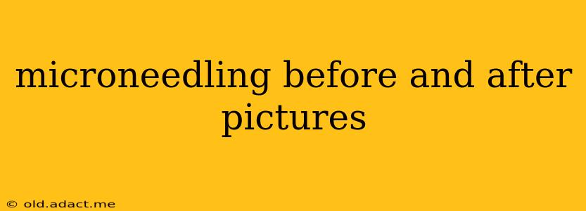 microneedling before and after pictures