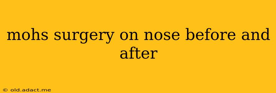 mohs surgery on nose before and after