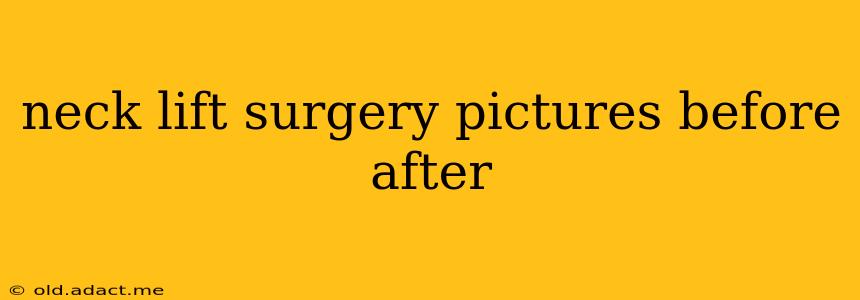 neck lift surgery pictures before after