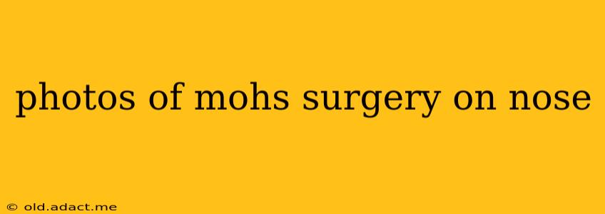 photos of mohs surgery on nose