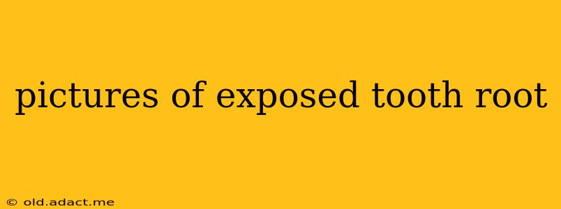 pictures of exposed tooth root