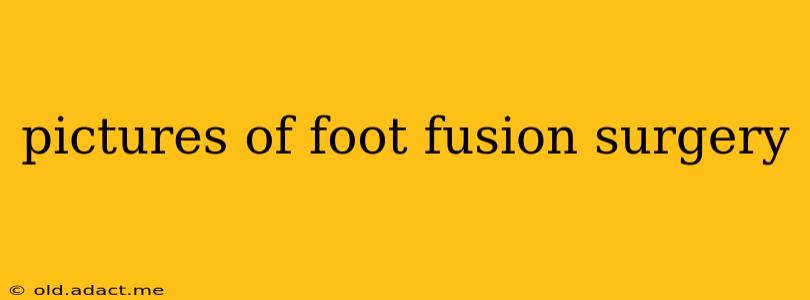 pictures of foot fusion surgery