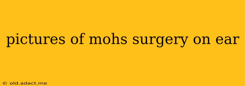 pictures of mohs surgery on ear
