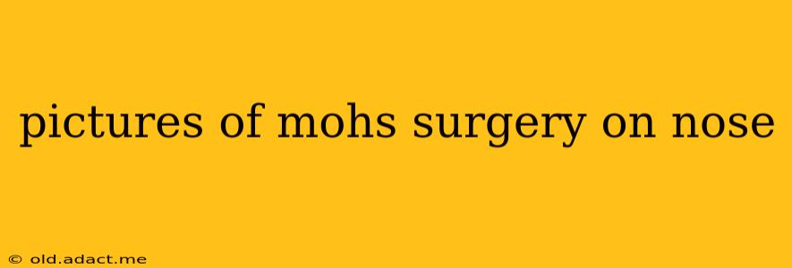 pictures of mohs surgery on nose