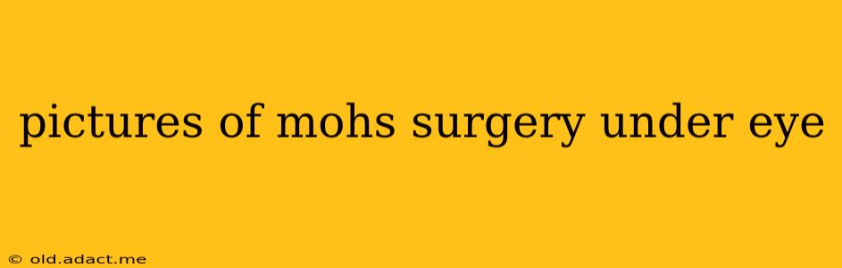 pictures of mohs surgery under eye