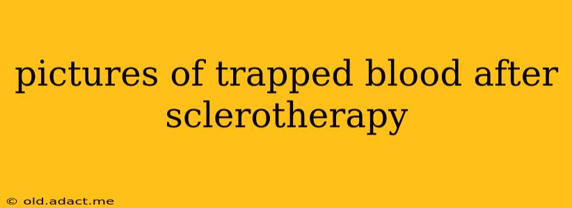 pictures of trapped blood after sclerotherapy