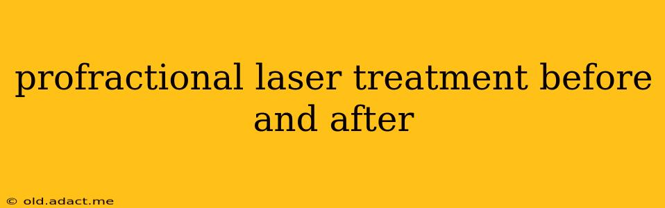 profractional laser treatment before and after