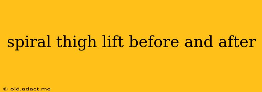 spiral thigh lift before and after
