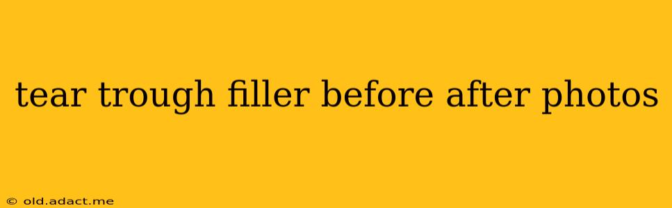 tear trough filler before after photos