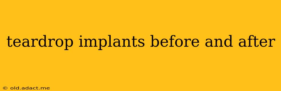 teardrop implants before and after