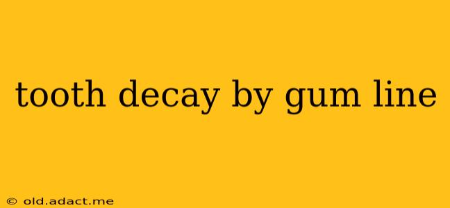 tooth decay by gum line