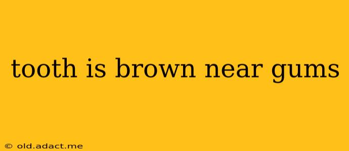 tooth is brown near gums