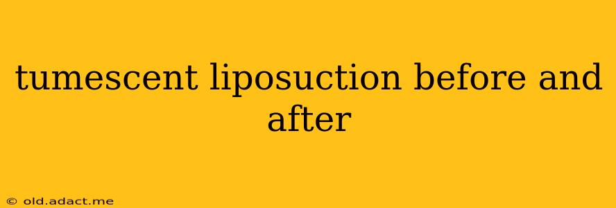 tumescent liposuction before and after