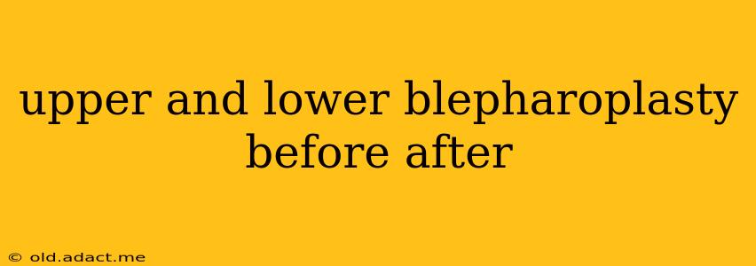 upper and lower blepharoplasty before after