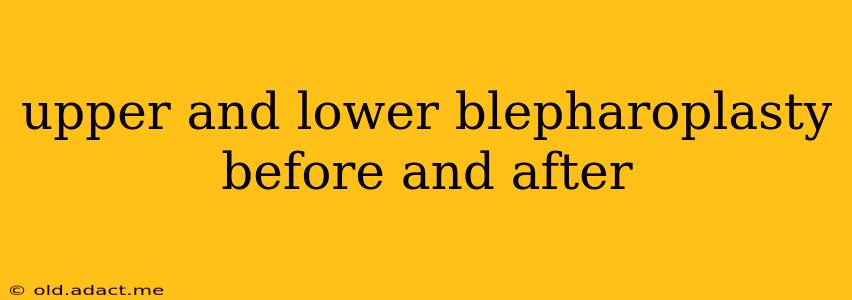 upper and lower blepharoplasty before and after