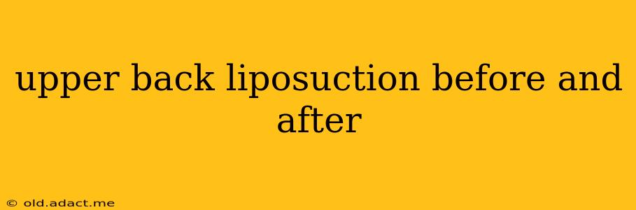 upper back liposuction before and after