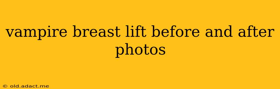vampire breast lift before and after photos